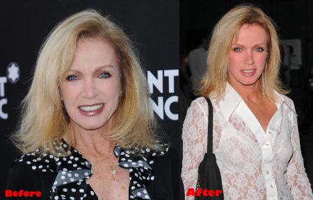 Donna Mills appears much younger than her age, so we believe she might have undergone plastic surgery.